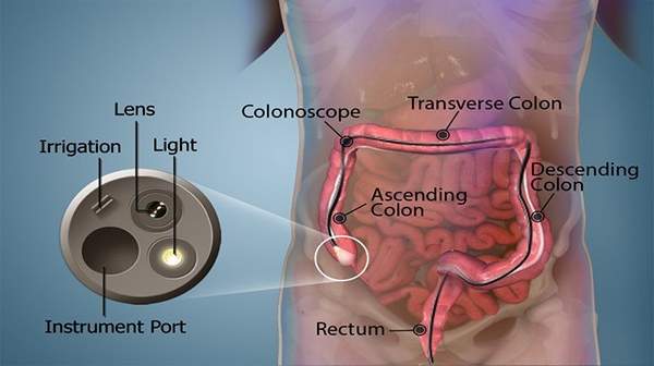 Picture of Colonoscopy