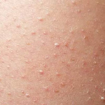 Keratosis Pilaris: Cause, Treatments, and Prevention - WebMD