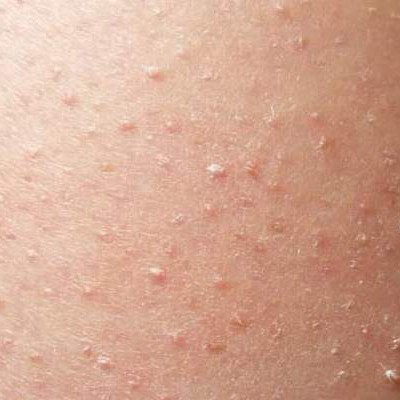 Keratosis pilaris - huidziekten.nl