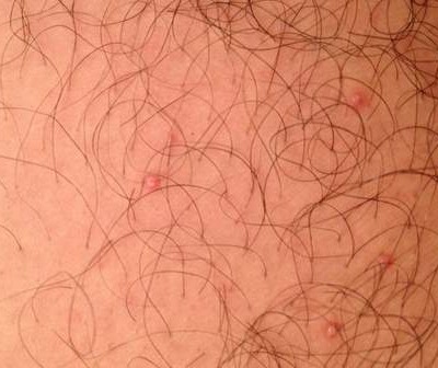 Genital warts inside the thigh