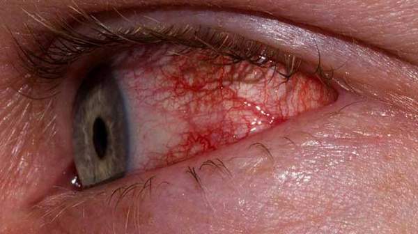 Picture of Allergic Conjunctivitis