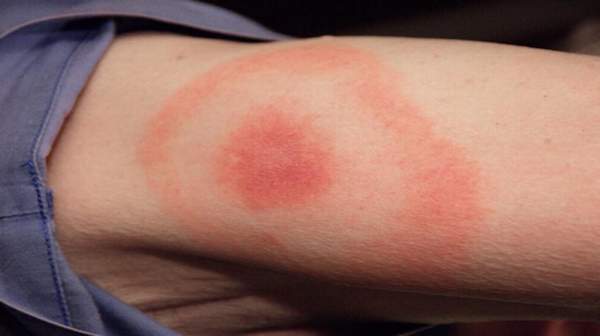 Picture of Lyme disease