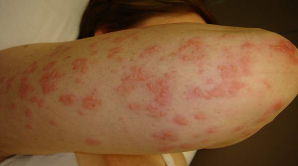 Picture of Dermatitis herpetiformis