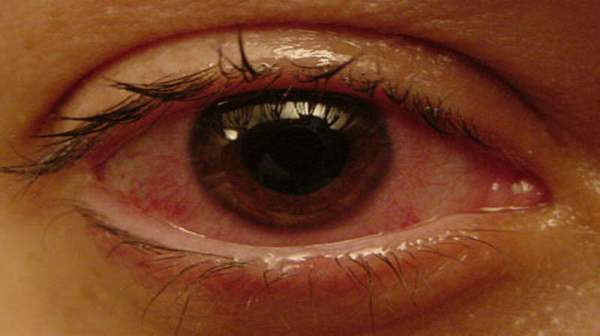 Pictureof Chorioretinitis