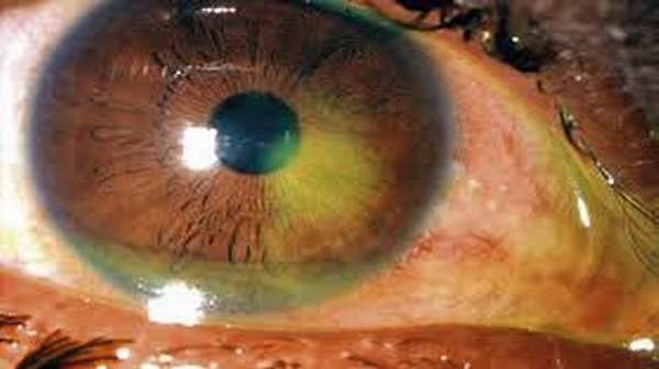 Picture of Corneal abrasion