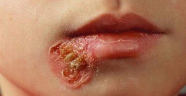 Bacterial Infection