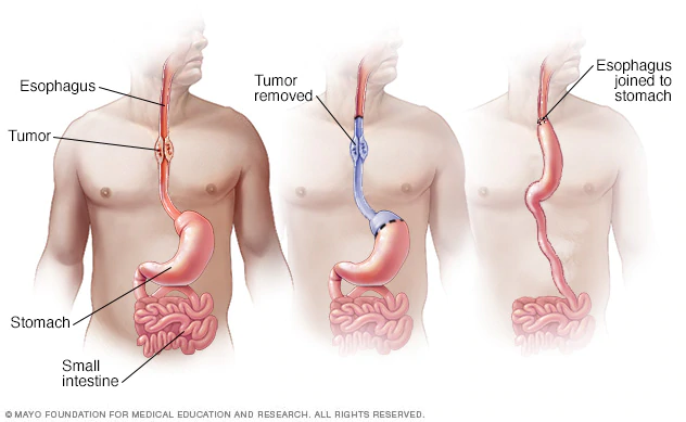 Esophageal cancer