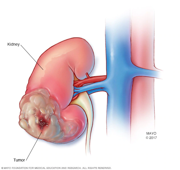 Kidney Cancer