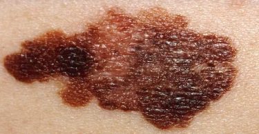 Melanoma