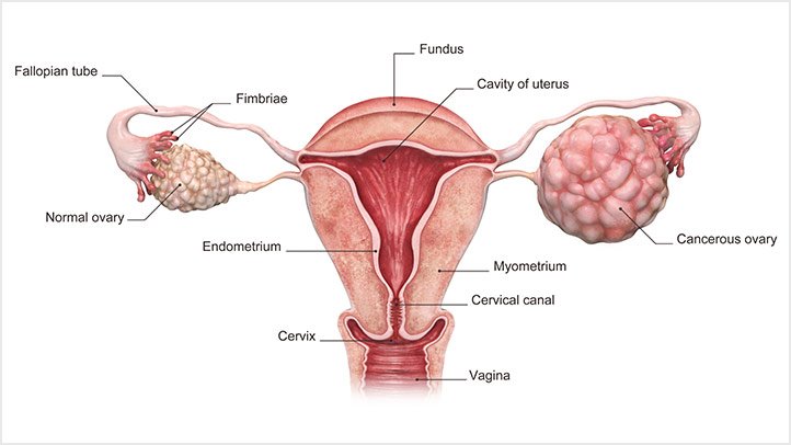 ovarian cancer