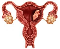 uterine cancer