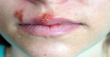 most common genital herpes in women