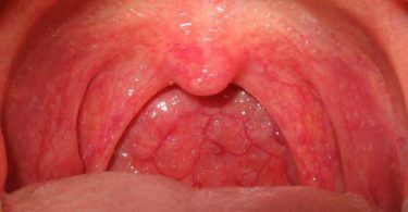 Pharyngitis