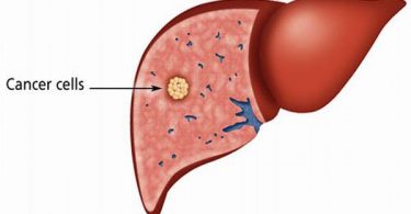 iver cancer symptoms, liver cancer survival, liver cancer survival rate, liver cancer stages, liver cancer life expectancy, liver cancer treatment, liver disease, metastatic liver cancer.