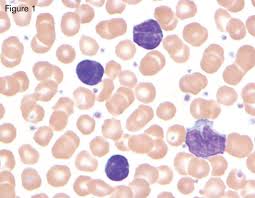 reactive lymphocytosis