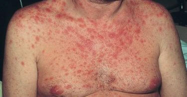 HIV rash in men