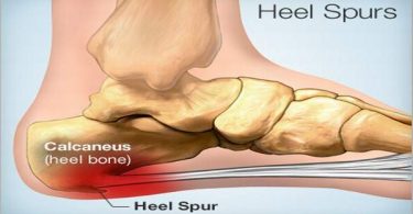 Heel Spur