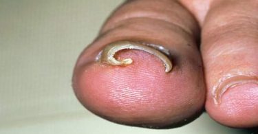 Ingrown Toenails