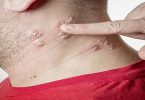 Is Shingles Contagious?