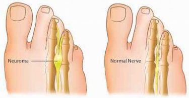 Morton's Neuroma