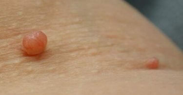 Skin Tags