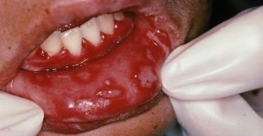 stomatitis