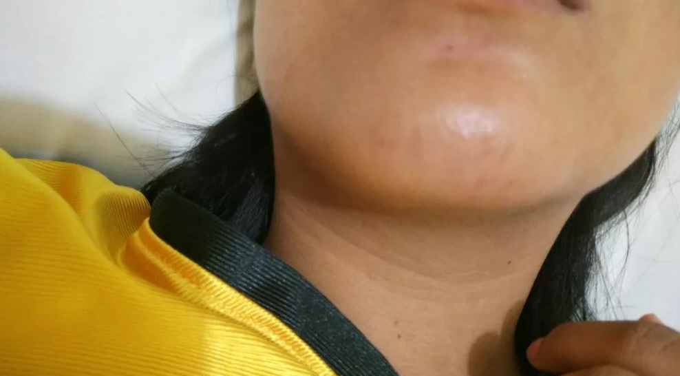 Hives on neck