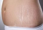 Home Remedy for Remove Stretch Marks