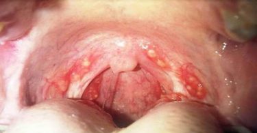 Image of strep throat infection