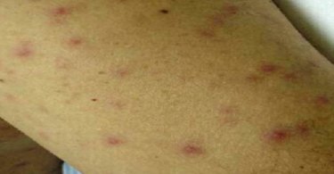 Typhus: Causes, Symptoms & Diagn