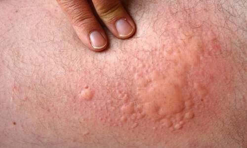 causes of hives
