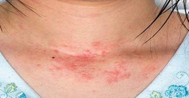 Rash Symptoms, Treatment, Causes