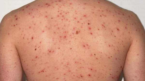 Difference Between HIV Rash and Chickenpox