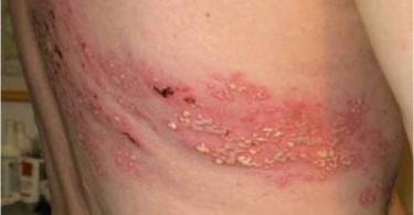 Hidradenitis Suppurativa