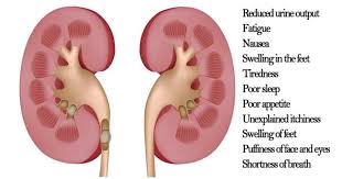 Kidney Cancer symptoms