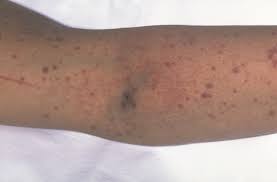 Petechiae Pictures Causes symptoms