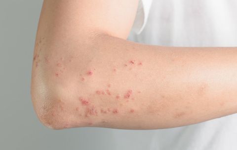 Photo of Hives (Urticaria)