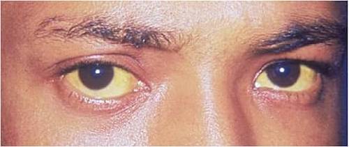 Jaundice Types, Symptoms, Causes & Treatments