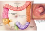 colon cancer