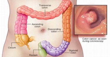 colon cancer