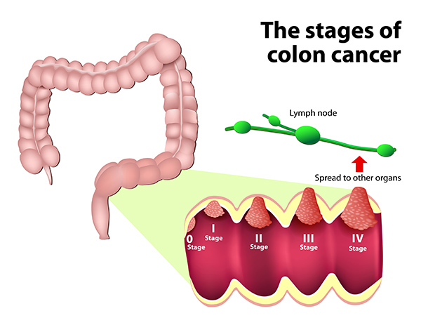 colon cancer