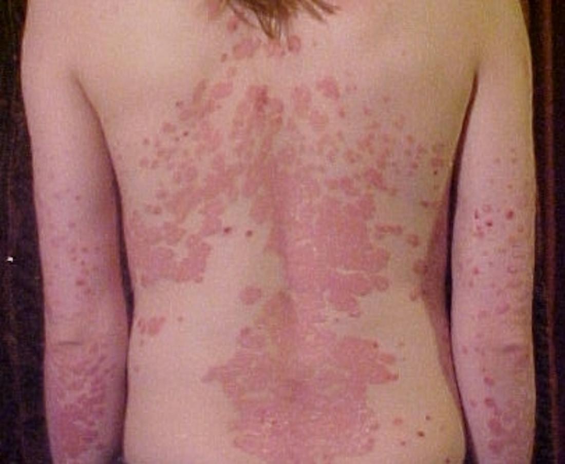 erythrodermic psoriasis