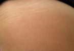 Risk for Developing Stretch Marks