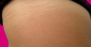 Risk for Developing Stretch Marks