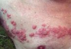 Shingles, rash