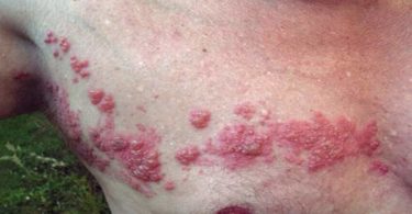 Shingles, rash