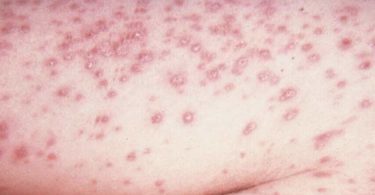 Histoplasmosis causes, Histoplasmosis symptoms, Histoplasmosis treatments