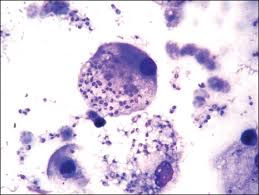 Histoplasmosis causes, Histoplasmosis symptoms, Histoplasmosis treatments