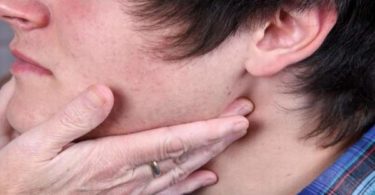 mononucleosis causes, mononucleosis treatments