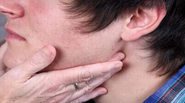 mononucleosis causes, mononucleosis treatments